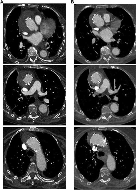 Postoperative Computed Tomography Ct Scan Axial Slices At 1 Week Download Scientific