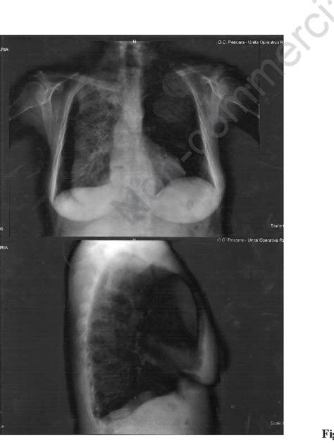 Figure 1 from Respiratory symptoms of megaesophagus | Semantic Scholar