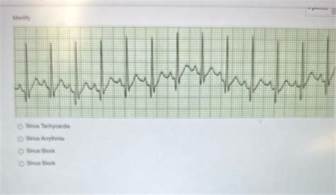 Solved Identify Sinus Tachycardia Sinus Arrythmia Sinus Block Sinus