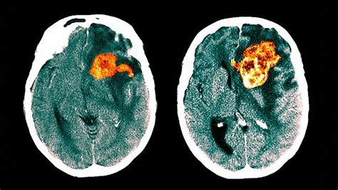 What Is Glioblastoma Symptoms Causes Diagnosis Treatment And