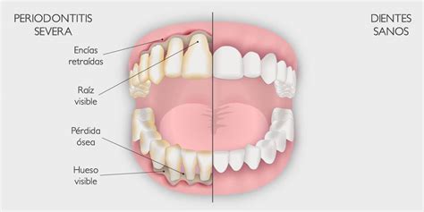 Periodontitis Causas S Ntomas Y Tratamientos Eficaces Para Combatirla