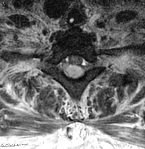 Discitis Osteomyelitis With Epidural Collection Image