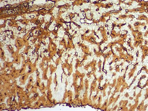 Liver Biopsy Demonstrating Staining Of Amyloid Light Chain Kappa And