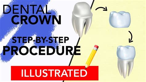 Dental Crown Step By Step Procedure Illustrated Youtube