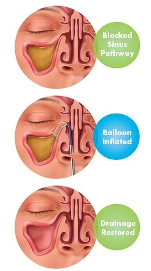 Sinusitis Treatment That Lasts! | ENT Specialists In Chicago, IL ...