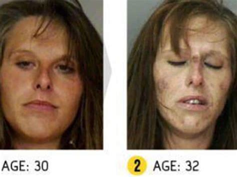 Drug Addiction Before And After Photos Show Shocking Reality Of Addicts