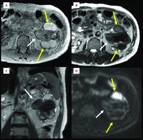 Magnetic Resonance Imaging Of An Acquired Cystic Disease Associated