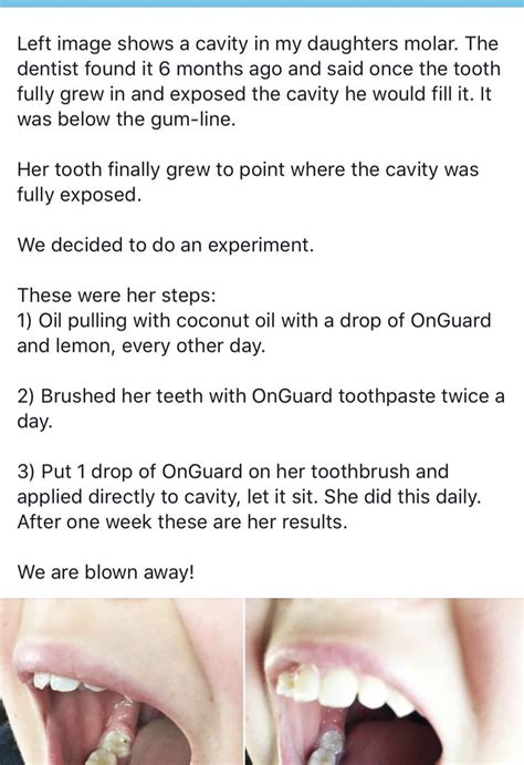 On Guard Oil Pulling method Oil Pulling Cavities, Oil Pulling Teeth ...