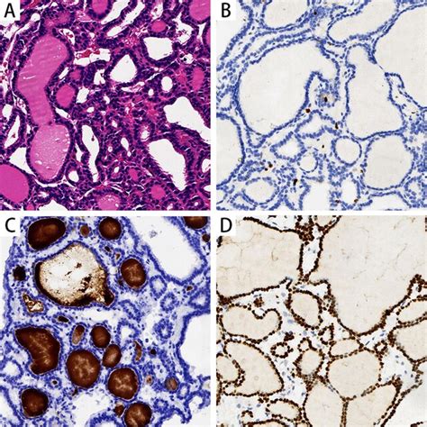 Microphotograph Of Pulmonary Ectopic Thyroid Glands A H E Show