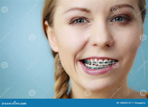 Closeup of Woman Teeth with Braces, Funny Face Stock Image - Image of dentistry, close: 140653121