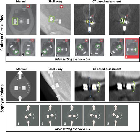 Computed Tomography Based Assessment Of Programmable Shunt Valve