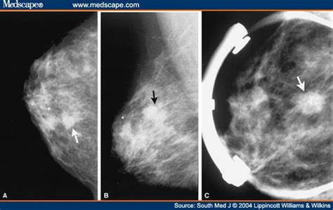 Mammography: Spot Compression Mammography