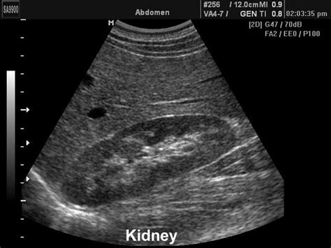 Normal Kidney Ultrasound