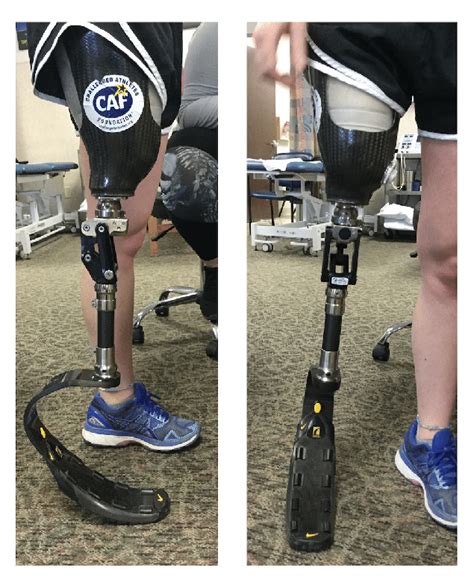 Static Alignment Of Prosthesis With Patient Loading Sound And Involved Download Scientific