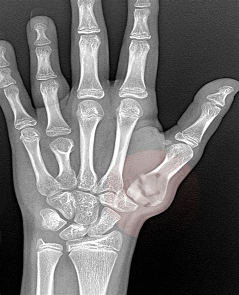 Figure Bennett Fracture Image Courtesy Sbhimji Md Statpearls