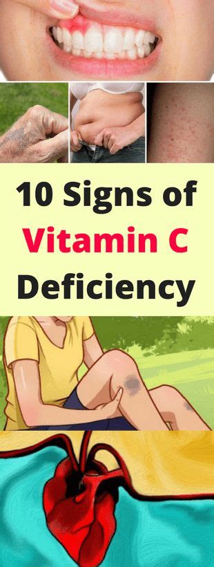 Here 10 Signs Of Vitamin “c” Deficiency Health Recipes