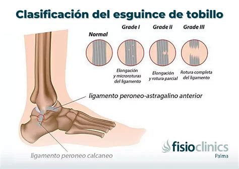 Diferencia Entre Esguince De Tobillo Y Fractura Con Tabla General The