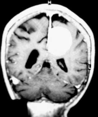 Brain Meningioma Imaging Practice Essentials Radiography Computed