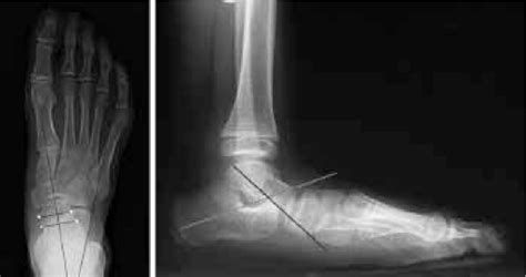 Anterior and lateral talocalcaneal angle. On anteroposterior radiograms ...