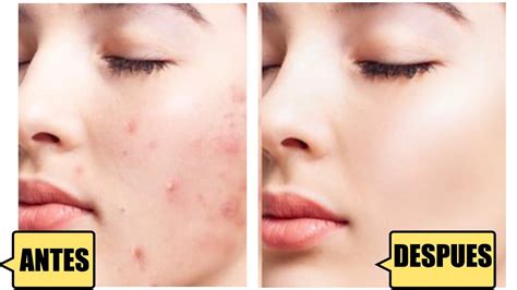 COMO ELIMINAR MARCAS DE ACNE RAPIDO EN 1 DIA Natural YouTube