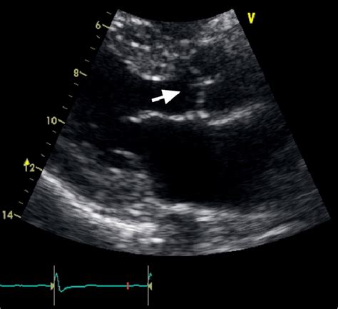 Two Dimensional Transthoracic Echocardiogram Parasternal Long Axis