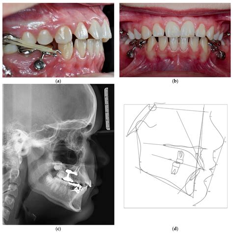 Bioengineering Free Full Text Concept For The Treatment Of Class