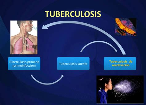 UANL punta de lanza en la detección de la tuberculosis Universidad