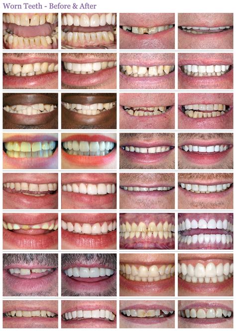 Worn Teeth Gallery Archives The Perfect Smile Studios