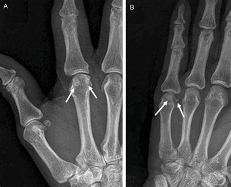 Sesamoid Bone Hand