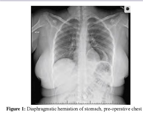 Figure From Congenital Diaphragmatic Hernia With Extra Lobar