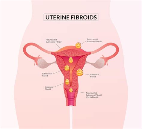 Premium Vector Scientific Medical Illustration Of Uterine Fibroids