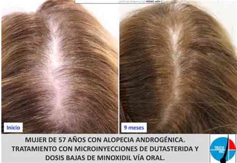 Tres Estrategias Efectivas Para Combatir La Alopecia En Mujeres Neurat