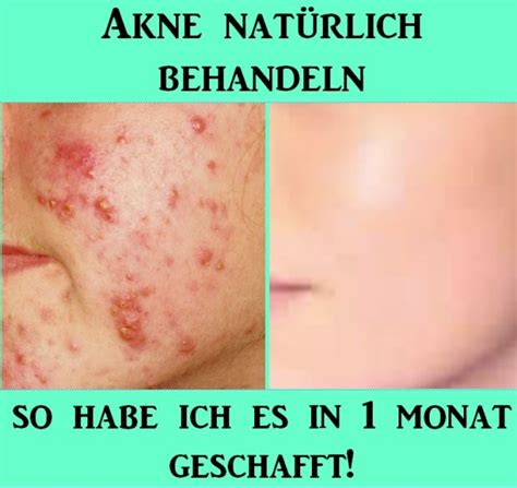 Akne Nat Rlich Behandeln Akne Akne Hausmittel Hormonelle Akne