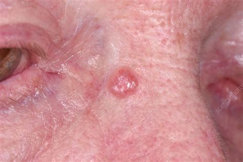 Basal Cell Carcinoma Types