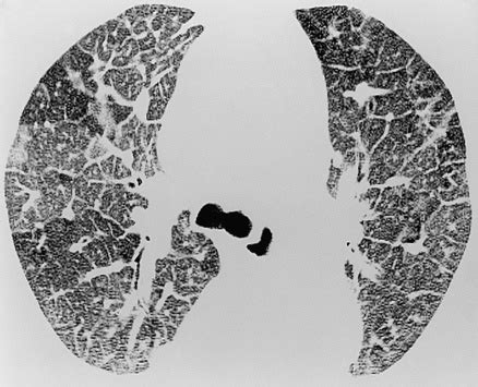 Airspace disease | Radiology Key