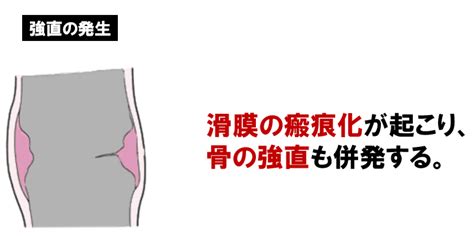 関節リウマチについて正しいのはどれか【第53回理学療法士国家試験am87】 — 理学療法士国家試験対策ptes