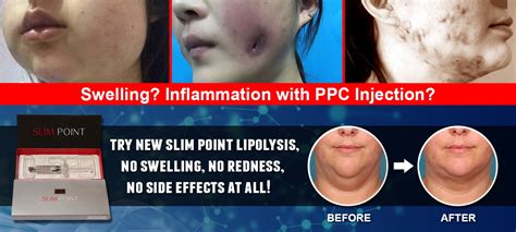 New Lipodissolve Solution Slim Point Lipolysis Injection Compares To Lipo Lab Ppc