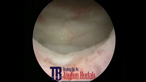 Mesanede L Koplaki Leukoplakia Of The Bladder Op Dr Tayfun Budak Youtube