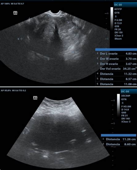 Right Ovarian Fibrothecoma Case Report Medcrave Online