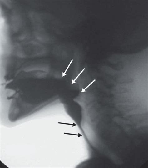 Lateral Fluoroscopic View Of A Year Old Man Who Has Undergone A