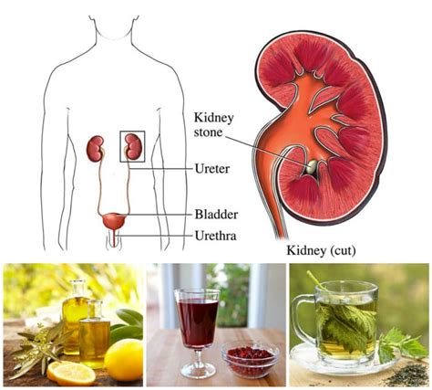 8 Natural Remedies For Kidney Stones