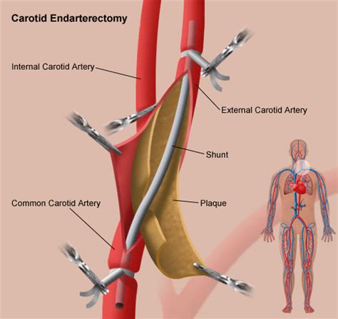 Carotid artery surgery risks elderly | Astral Projection