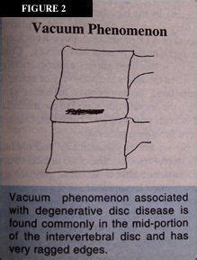 Lumbar Spine: Vacuum Phenomenon Lumbar Spine