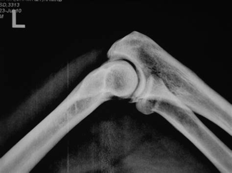 Case Lateral Radiograph Of Left Elbow Showing Mason Type Radial