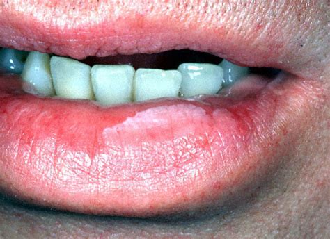 Leukoplakia Pictures Causes Symptoms Treatment And Prevention