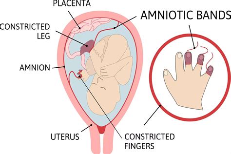 What Is Amniotic Band Syndrome And What Are Its Causes Being The Parent