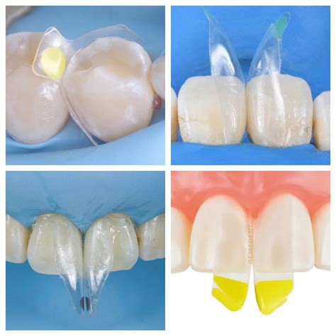 Clear Matrix Dental Anterior Matrices Posterior Class II Fit BioClear