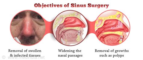 Sinus Surgery - Facts, Preparation, Operative Procedure, Recovery ...