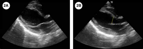 Cardiac Point Of Care Ultrasound In Pediatric Neurocritical Care A