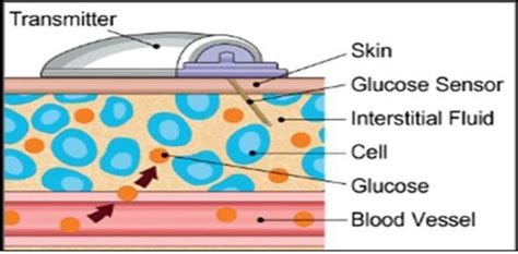 Fifteen Minute Consultation Practical Use Of Continuous Glucose Monitoring Adc Education